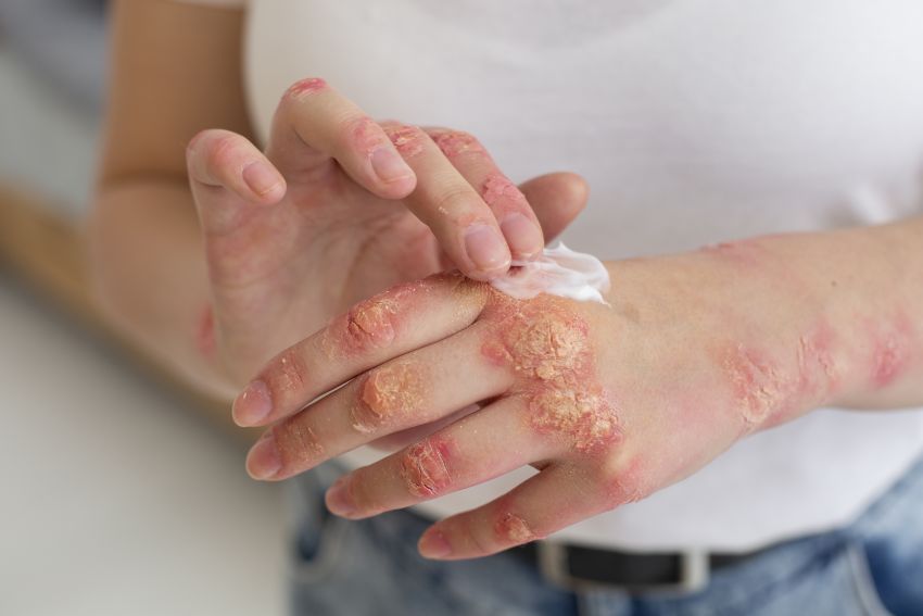 hands with eczema