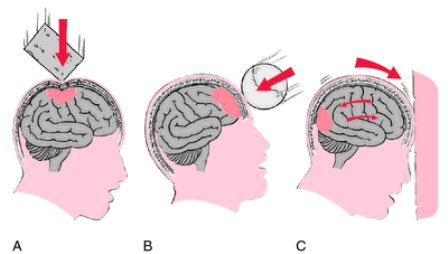 È comune sviluppare la demenza dopo un colpo in testa?