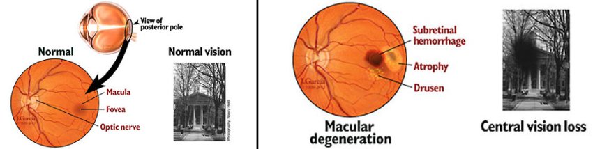 healthy and macular degeneration affected eyeball