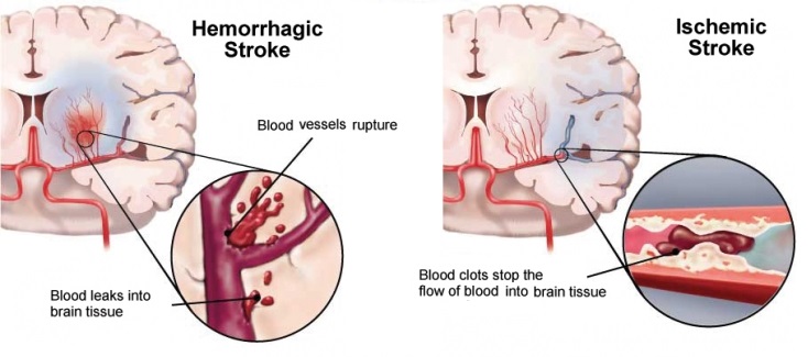hemorhagic vs ischemic stroke