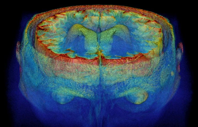 Scansioni cerebrali ad alta risoluzione danno indizi sulla perdita di memoria degli anziani