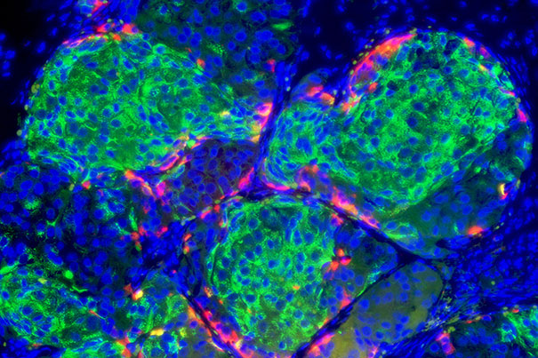 Passo da gigante contro il diabete: cellule staminali diventano cellule beta produttrici di insulina