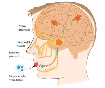 infezione hsv1 e cervello