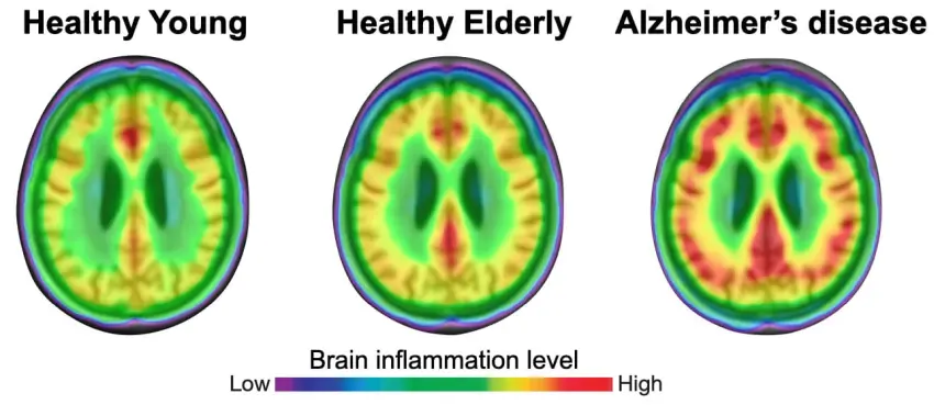 inflammation level in healthy and alzheimer brains