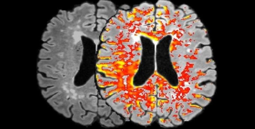 leaks in blood brain barrier