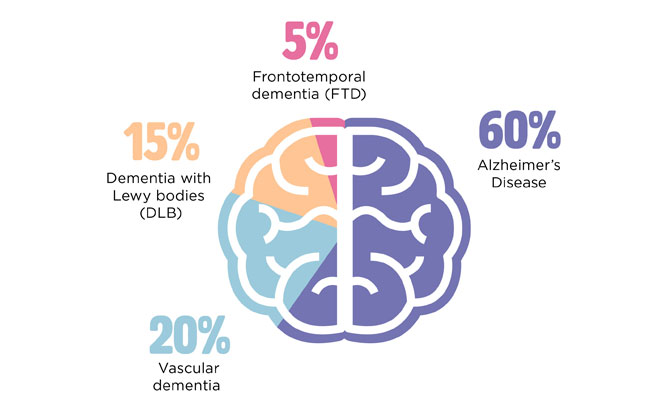 Cos'è la demenza vascolare e come ridurre il rischio di averla?