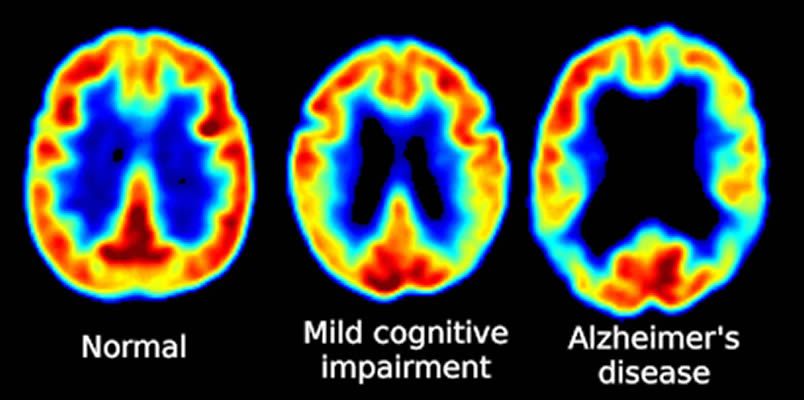 normal, mci and alzheimer's affected brain scans