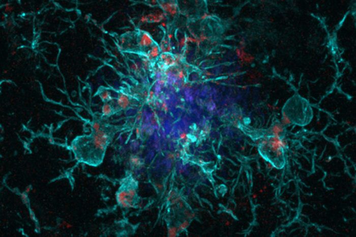 microglia turquoise around plaque blue with red dots prepared to remove it
