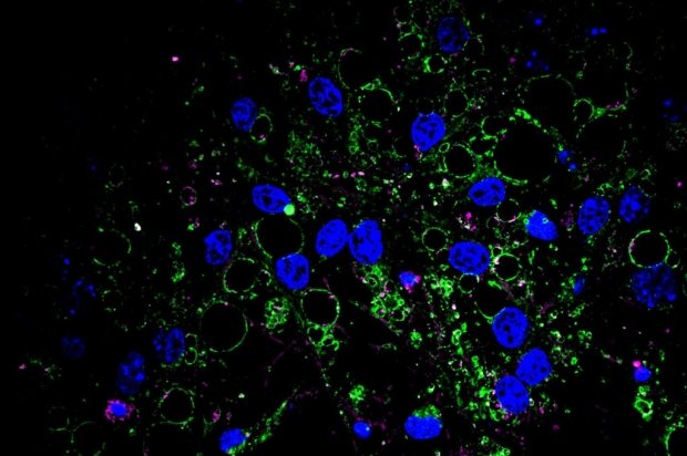 Eliminare i grumi di proteine nelle cellule staminali neurali invecchiate aumenta la loro attività