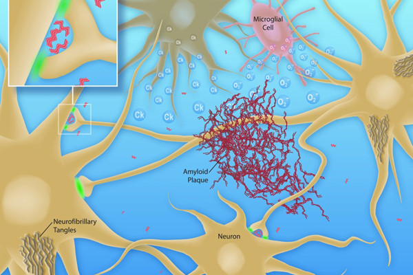 neuron alzheimers plaque