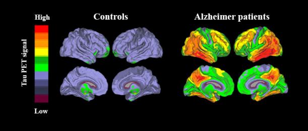 New imaging method to detect Alzheimer