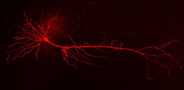 Nell'Alzheimer le cellule nervose (neuroni) hanno una forma diversa