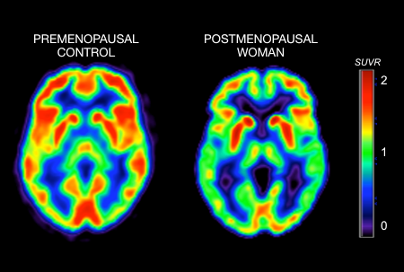 La menopausa innesca cambiamenti metabolici nel cervello che possono portare all'Alzheimer