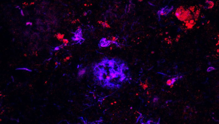Un anticorpo rimuove le placche di Alzheimer, nei topi