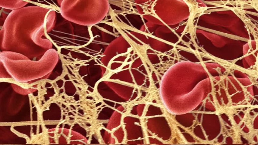 red blood cells trapped in fibrin mesh