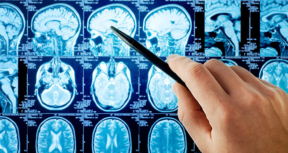 Le scansioni cerebrali possono distinguere due diversi tipi di demenza