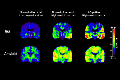 Le scansioni PET mostrano l'evoluzione dell'Alzheimer dal vivo.