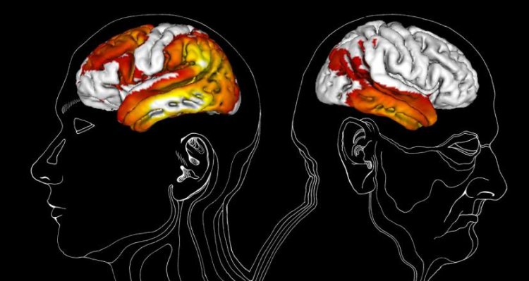 Nuovo metodo visualizza i danni dell'Alzheimer nelle varie fasi