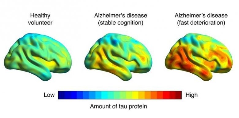 tau content on healthy and alzheimer patients