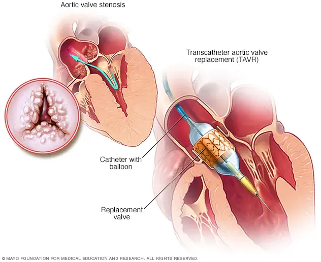 tavr transcatheter aortic valve replacement