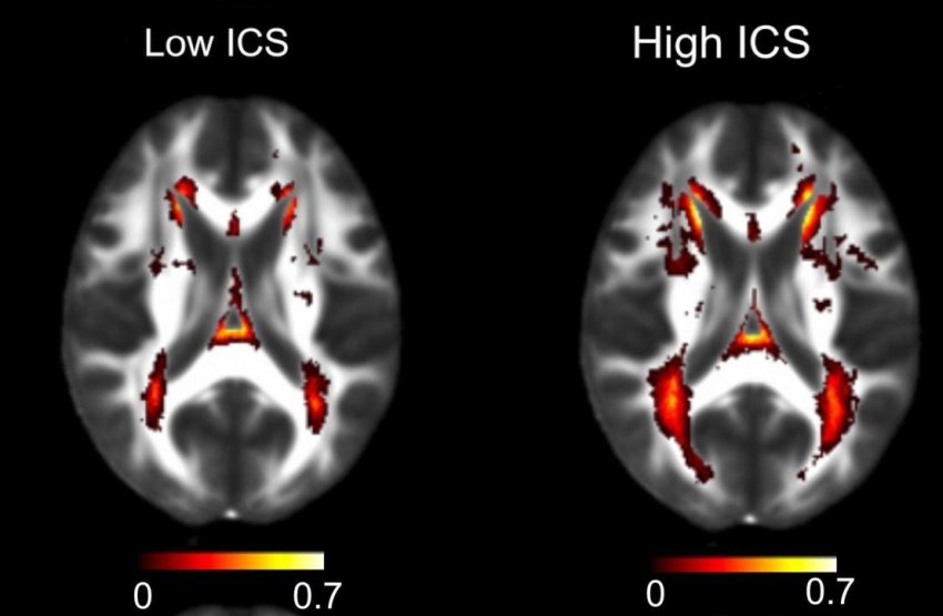 white matter brain damage with low and high inflammatory blood test scores